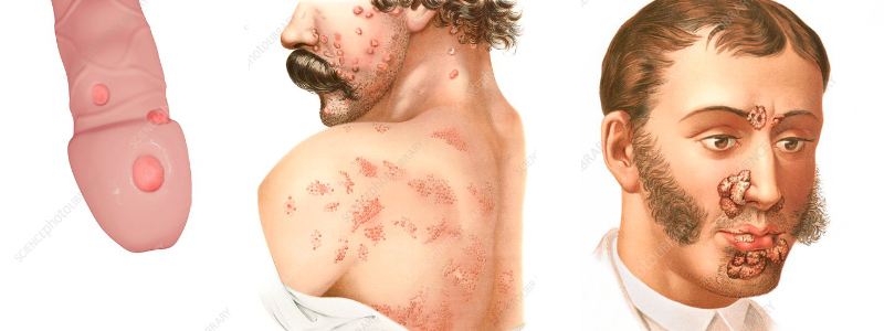 Symptôme de la syphilis, aux stades primaire, secondaire et tertiaire. Illustrations tirées du site Science Photo Library